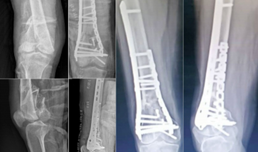 dual-plate-fixation-distal-femur-surgery-czmeditech