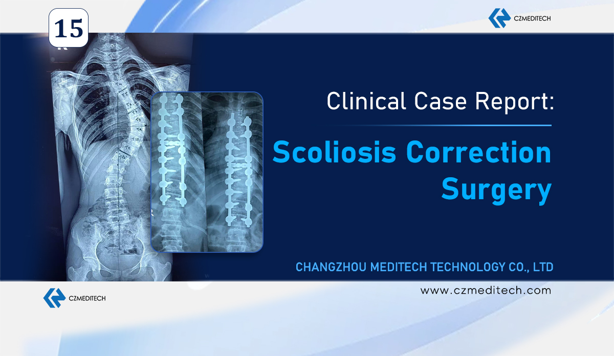 Kalan: Scoliosis correction opereli Daka, Bangaladeshi ni 6.0mm pedicle screw system ye .