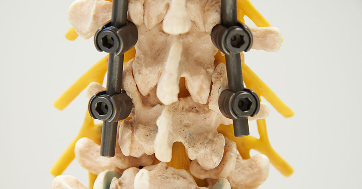 spinal pedicle screw