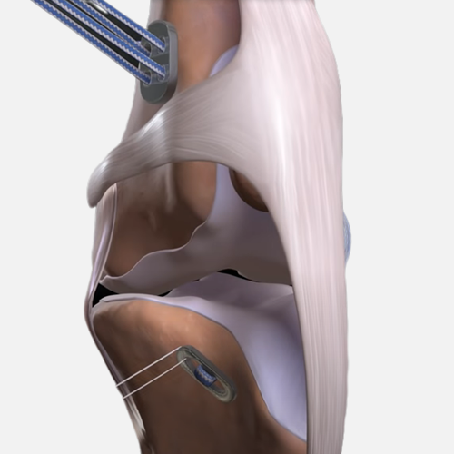 Artificial Ligament System