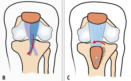 treatment patellofemoral joint instability in children