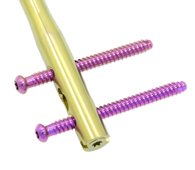 DFN Distal Femur Intramedullary Nail 