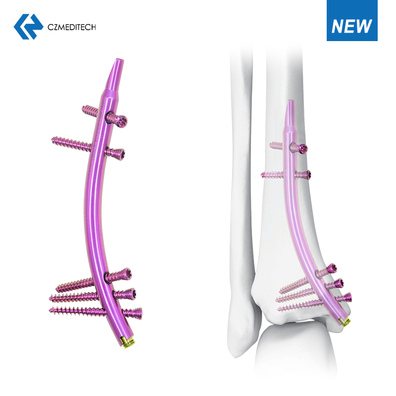 Distal Tibial Intendullary nail (DTN)