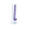 VA Distal Lateral Tibia Locking Plate