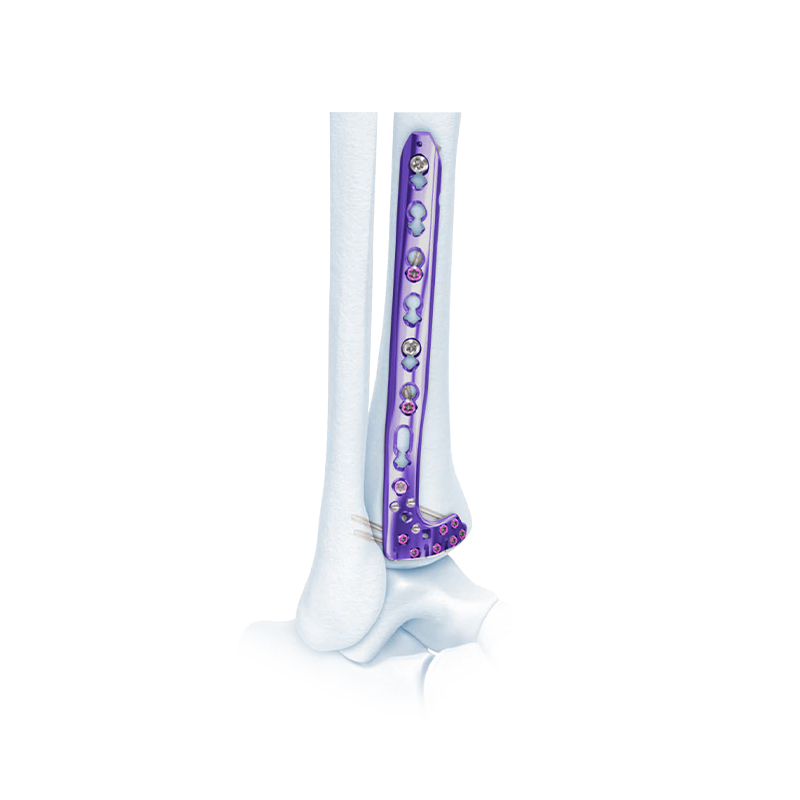 VA Distal Lateral Tibia Locking Plate