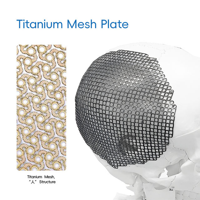 Titanium Mesh, "Λ" Structure