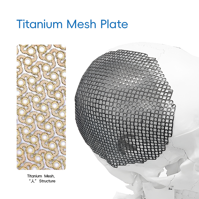 Titanium Mesh, "Λ" Structure