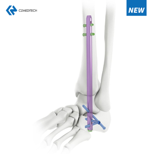 Hindfoot Fusion Ankle Nail