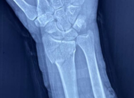 Distal Radius Fracture Surgery in Mexico &mdash; Using CZMEDITECH VA Locking Plate System1