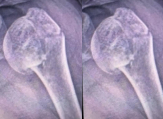 humeral-head-fracture-preoperative-xray-czmeditech