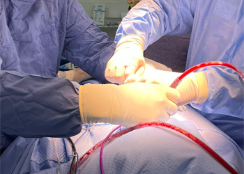 Intraoperative view of Uni-C Standalone Cervical Cage placement during anterior cervical fusion by CZMEDITECH 1