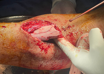 Intraoperative photo 1