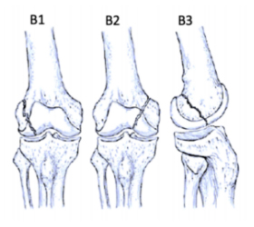 ao-classification-distal-femur-type-b