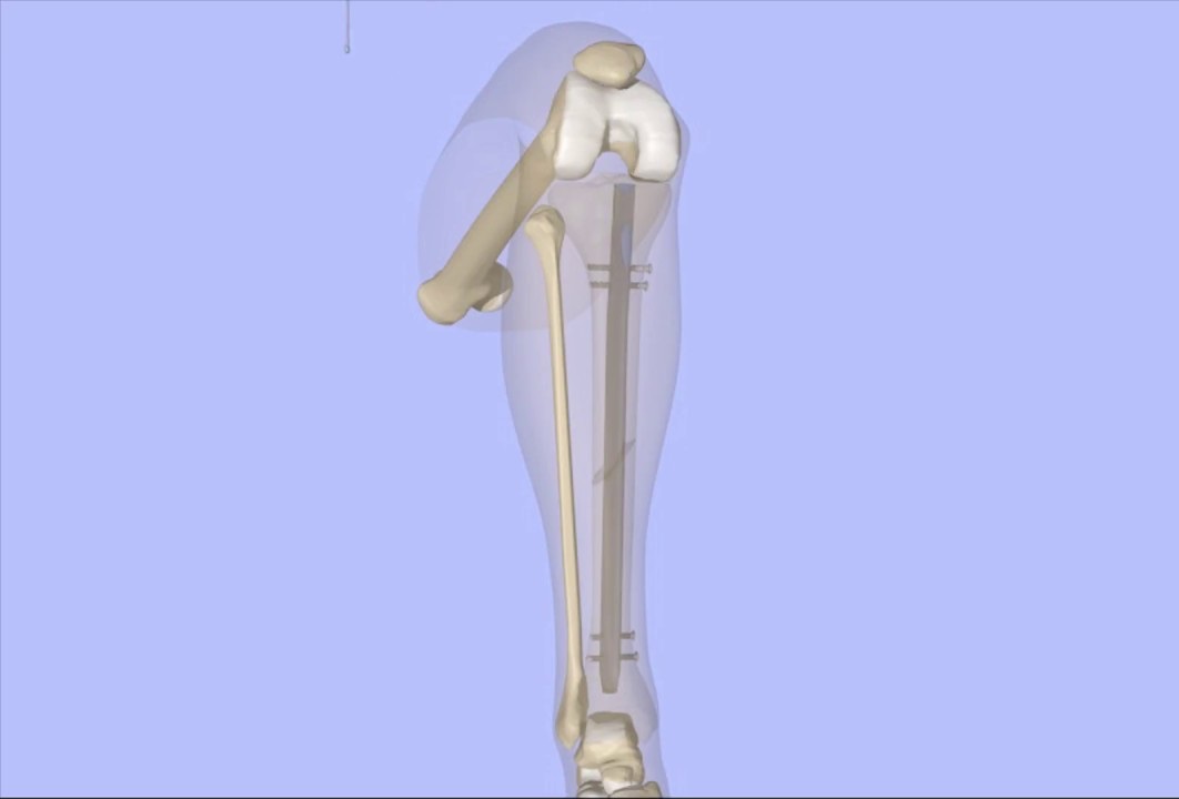 Tibial Intramedullary Nail: A Reliable Solution for Tibial Fractures
