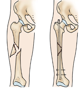 femoral-aci-narekahan-diperlakukeun-ku-intramedullary-kuku