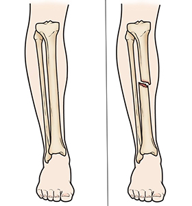 tibial-aci-narekahan-intramedullary-nailing-fiksasi