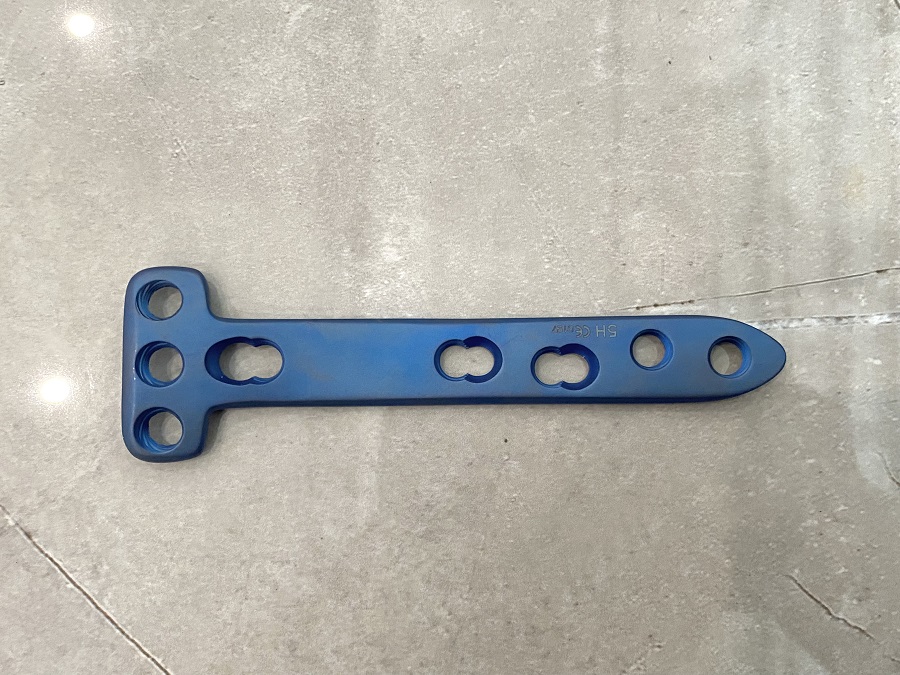 Lateral Tibial Head Buttress Locking Plate