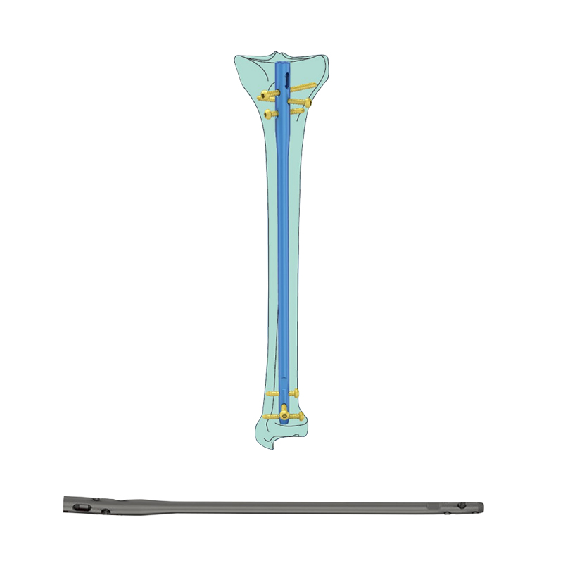 Suprapatellar-Approach-Tibial-Intramedullary-Nail