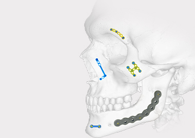 Mandible Plating System