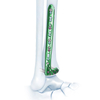 VA Distal Lateral Tibia Locking Plate
