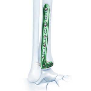 VA distale laterale tibia -sluitplaat