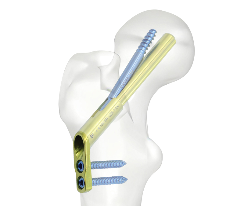 Femoral boyun sistemi
