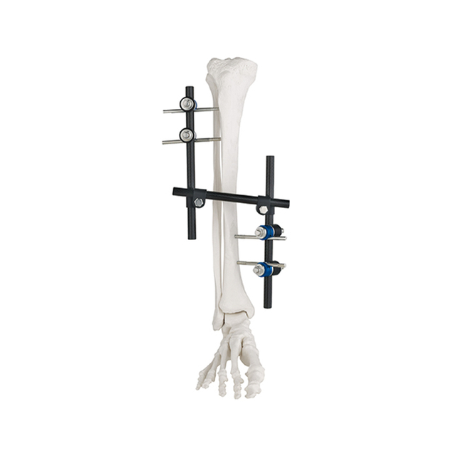 Z Type External Fixator