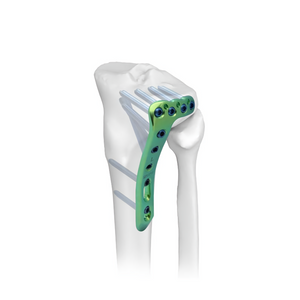 Proximal Lateral Tibial Locking Plate-II