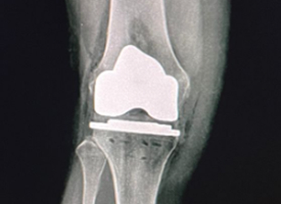 Knee Surface Replacement for Right Knee Deformity And Dysfunction-czmeditech6