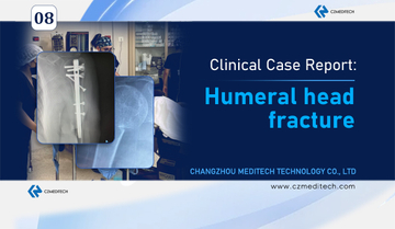 humeral-head-fracture-surgery-mexico-cover-czmeditech.jpg