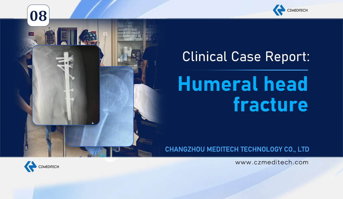 Case Study:Successful Treatment of A Humeral Head Fracture in Mexico