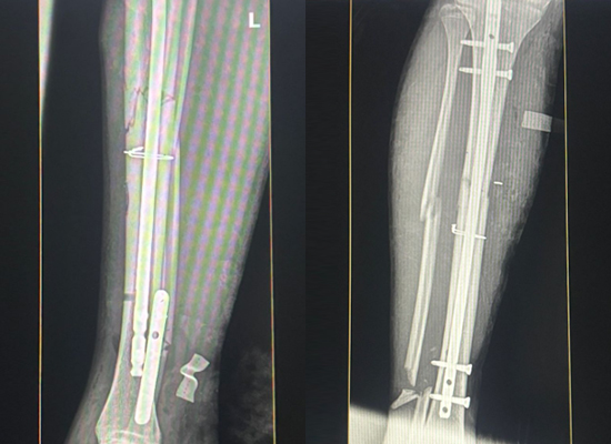 Postoperative X-ray showing healing