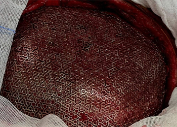 postoperative-cranioplasty-result-mexico-czmeditech