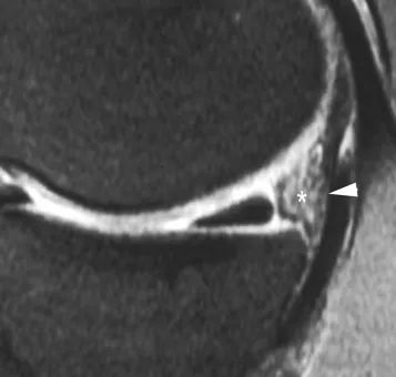 Detachment of the posterior horn of the meniscus