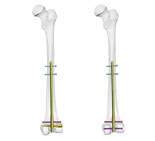 DFN Distal Femur Intramedullary Nail 
