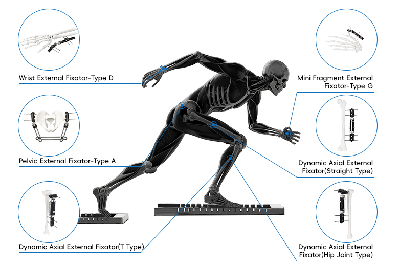 External Fixator System