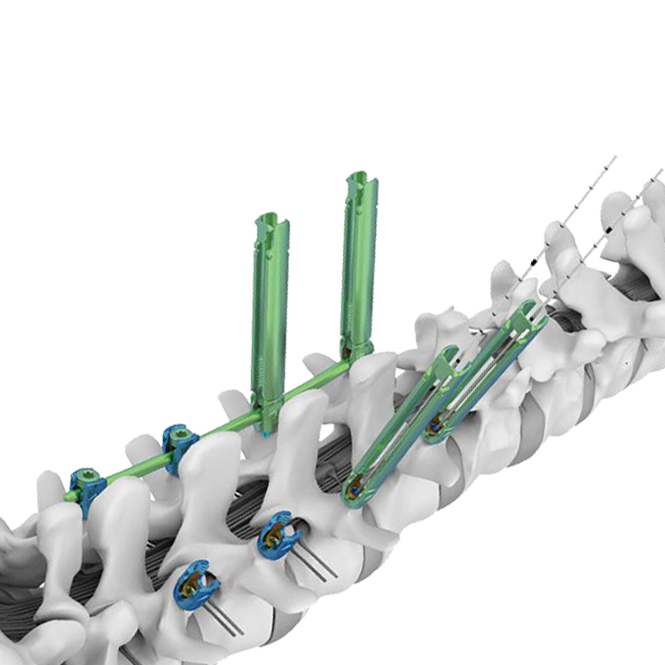 Posterior Cervical Screw System