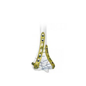Distal Lateral Humeral Locking Plate