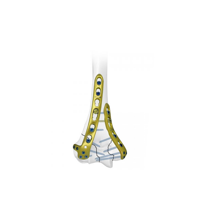Distal Lateral Humeral Locking Plate