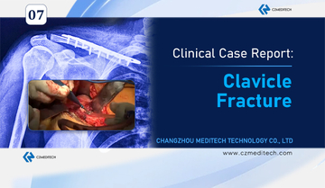 successful-clavicle-fracture-surgery-mexico-s-locking-plate-czmeditech.jpg