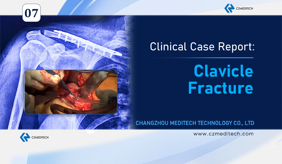 Case Study:Successful Clavicle Fracture Treatment with S-Clavicle Locking Plate