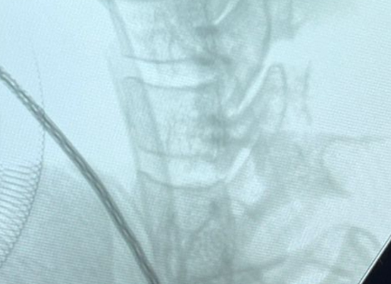 Preoperative cervical MRI showing disc herniation and OPLL before fusion surgery in Zapopan, Mexico
