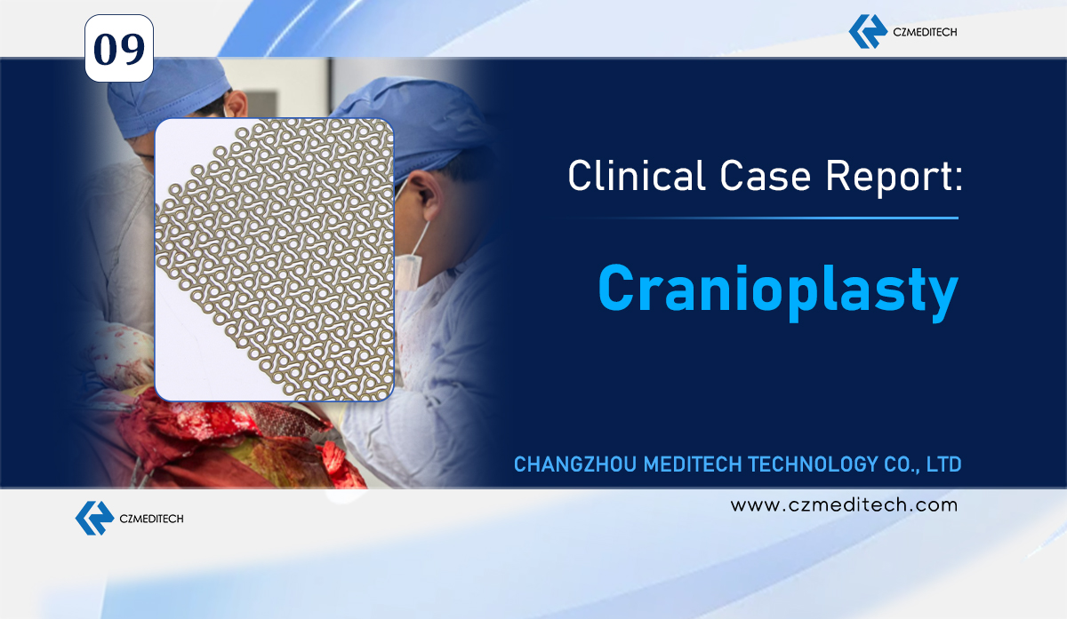 Case Study:Successful Cranioplasty Case in Mexico Using Titanium Mesh System