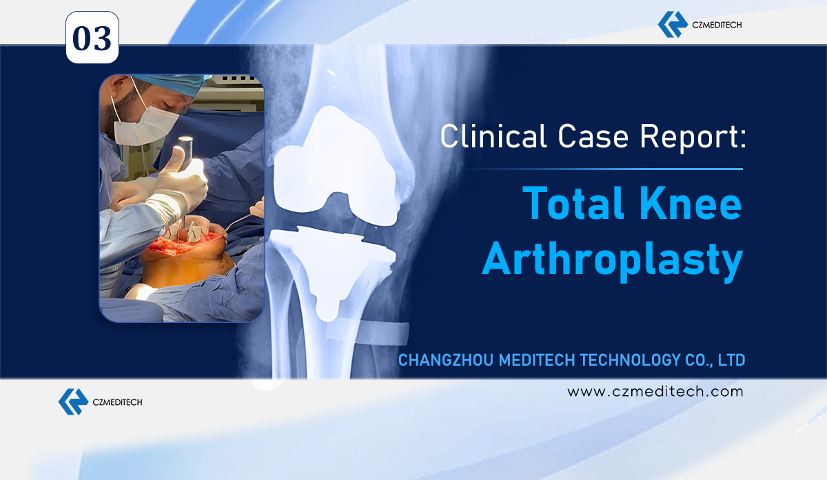 Mexico Total Knee Arthroplasty Case Sharing