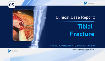 Tibial Fracture Treatment in Mexico Advanced Nail-Plate Fixation Case Study-czmeditech.jpg