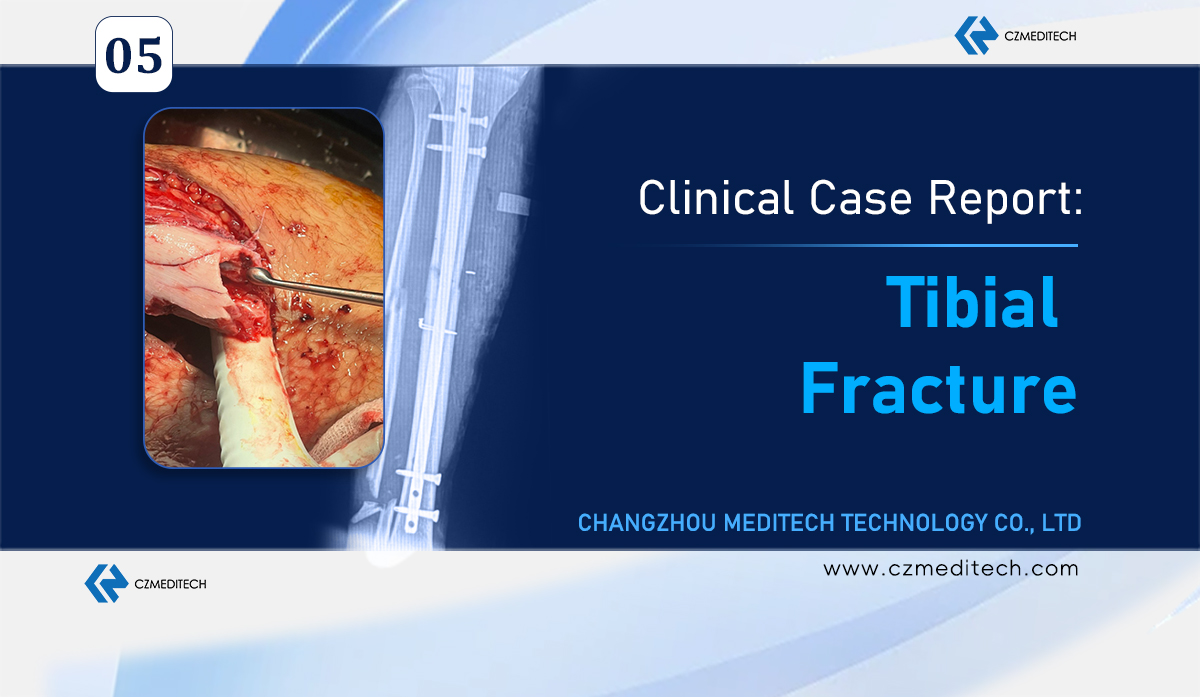 Successful treatment of a complex tibial fracture using expert-grade intramedullary nail and plate fixation