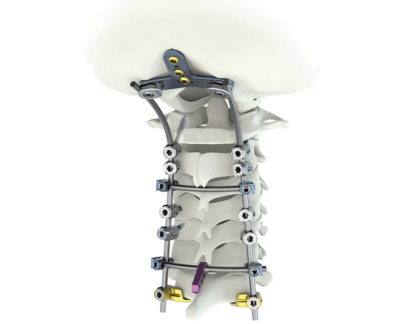 Do you know cervical spine fixation screw system?