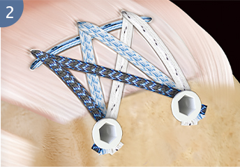 Polyethylene Suture