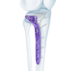 VA Proximal Tibia Locking Plate