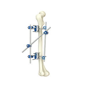 Half Ring External Fixator